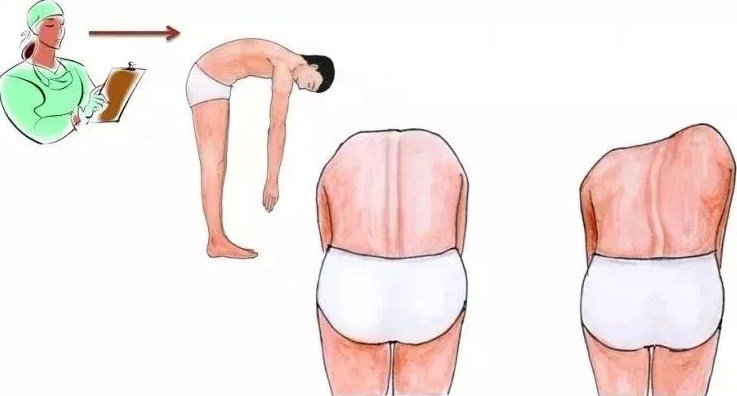 脊柱側(cè)彎早發(fā)現(xiàn)，早治療