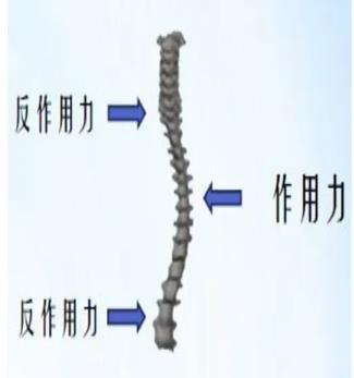 脊柱矯形器的治療原理
