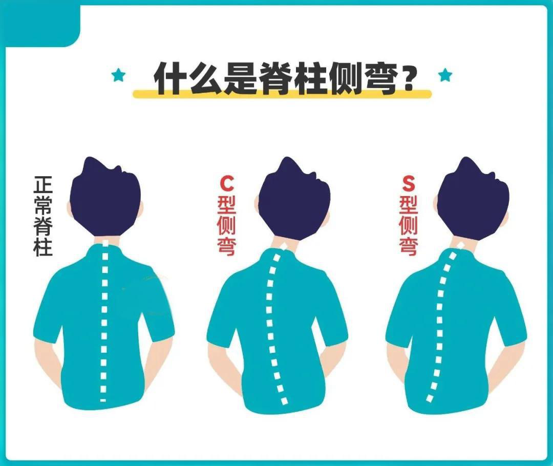 脊柱側彎與家庭自查