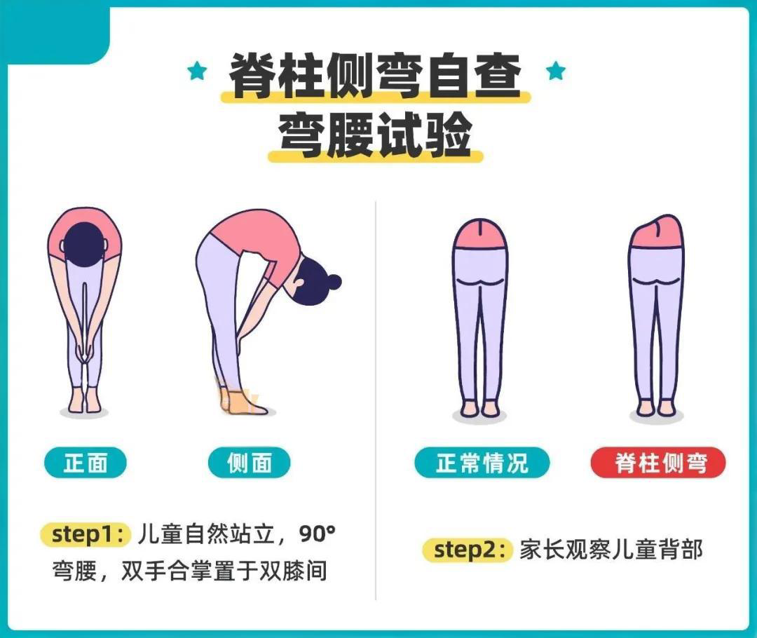 脊柱側彎與家庭自查