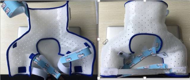 低溫板材在下肢骨折上的應(yīng)用